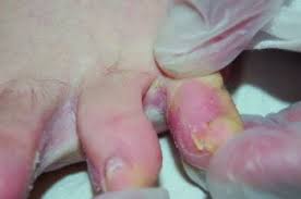 Close-up of athlete’s foot blisters on feet