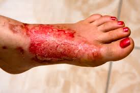 Second degree burns - blistering and redness on skin surface of the foot