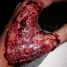 Third degree burns on hand - severe tissue damage, charred appearance