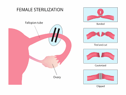 Female sterilization procedure - tubal ligation surgery