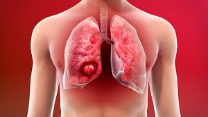 Medical illustration of a lung with a tumor, prominently located on the left lung.