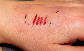 Abrasions on the hand: Common wounds requiring care