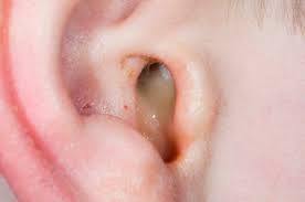 Pus-like discharge in child's ear classic symptom of ear infections