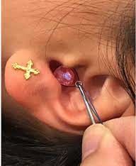 Removal of bead from ear