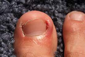 the corner or side of a toenail grows into the skin