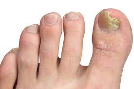 Toenail Fungal Infection