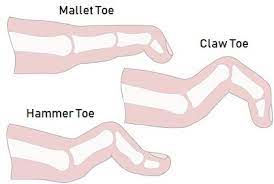 Toe Deformities: Claw, Hammer, and Mallet Toes - Common Foot Problems