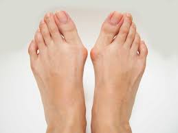 Foot Problems: Image of Bunions, Bony Bumps at Base of Big Toe