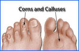 Foot with corns and calluses side by side