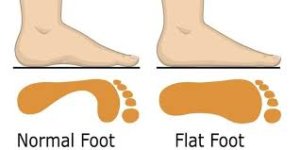 Flat Feet: When the Arch of the Foot Collapses or Flattens