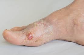 Foot problems: Diabetic Foot Lesions