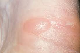 Blisters: Fluid-Filled Skin Lesions