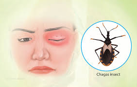 Person with swollen eye displaying Chagas disease symptoms near Trypanosoma cruzi parasite