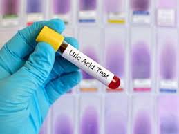 Uric Acid Testing: Blood Test Tube