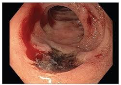 Illustration of a cross-section of the stomach showing a peptic ulcer