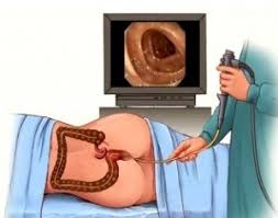 Patient undergoing colonoscopy procedure for IBS diagnosis