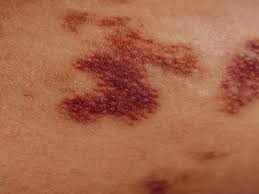 Skin rash, a common symptom of autoimmune diseases.