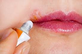 Person applying cream to a cold sore on the mouth