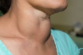 Woman displaying enlarged thyroid gland (goiter)