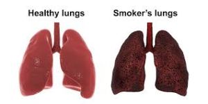 A healthy lung compared to a smoker's lung