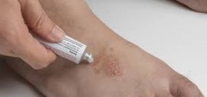 Applying antifungal cream to a lesion on the foot - Treatment for fungal skin infection