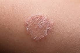 Skin rash - Potential symptom of ringworm infection