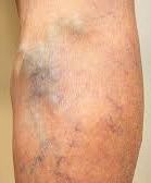 Image showing a blood clot in the leg.