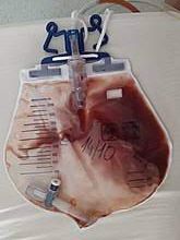 Blood visible in a Foley catheter drainage bag.