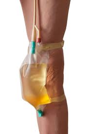 Image of a Foley catheter securely attached to a person's leg with a filled drainage bag, highlighting proper home care.