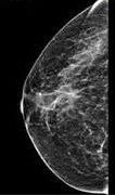 A mammograms image of the breast showing clear visualization for breast health assessment.