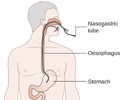 Nasogastric tube positioned inside the stomach for medical treatment