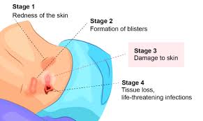 Illustration depicting progression through the stages of  pressure ulcers