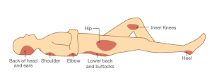 Detailed view of points prone to pressure ulcers on the body