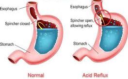 Image depicting the contrast between a normal pregnancy stomach and one affected by pregnancy heartburn or acid reflux.