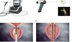 Visual representation of the Rezūm procedure, highlighting its innovative and minimally invasive approach to BPH treatment.