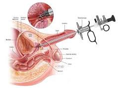 Visual representation of the Transurethral Resection of the Prostate (TURP) surgical procedure.