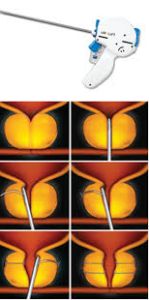 Visual depiction of the UroLift procedure, showcasing its minimally invasive approach for treating BPH.