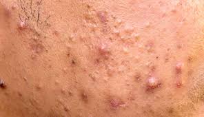 Hormonal imbalance causing many pimples on the skin of an individual.