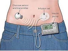 insulin pump attached to waist for diabetes management