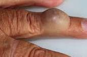 Image of a cyst-like lump on the finger, illustrating characteristics and appearance of lumps in the body.