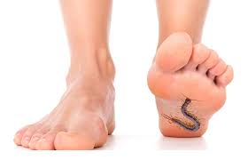 Person stepping on a centipede, preventing a potential centipede bite.