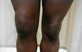 Close-up of swollen knee beside a normal one - Knee Fluid Drainage considerations.