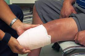 Bandaged leg highlighting health complications post-amputation