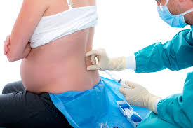 Pregnant woman receiving a spinal injection for epidural medication during labor.