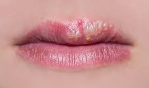 Image of a cold sore on the lip, also known as a fever blister, caused by the herpes simplex virus (HSV).
