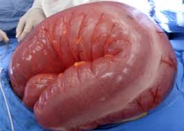 Close up of an enlarged colon showing abnormal dilation