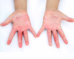 Toxic shock syndrome rash on hands