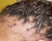 Inflamed and itchy patches on the scalp