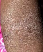 A rash on the arm